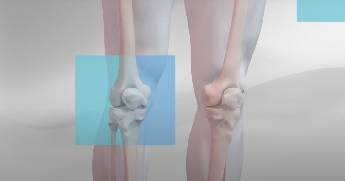 Biologically Optimized ACL Technique (BOAT Protocol): A Modern Approach to Reconstruction and Recovery