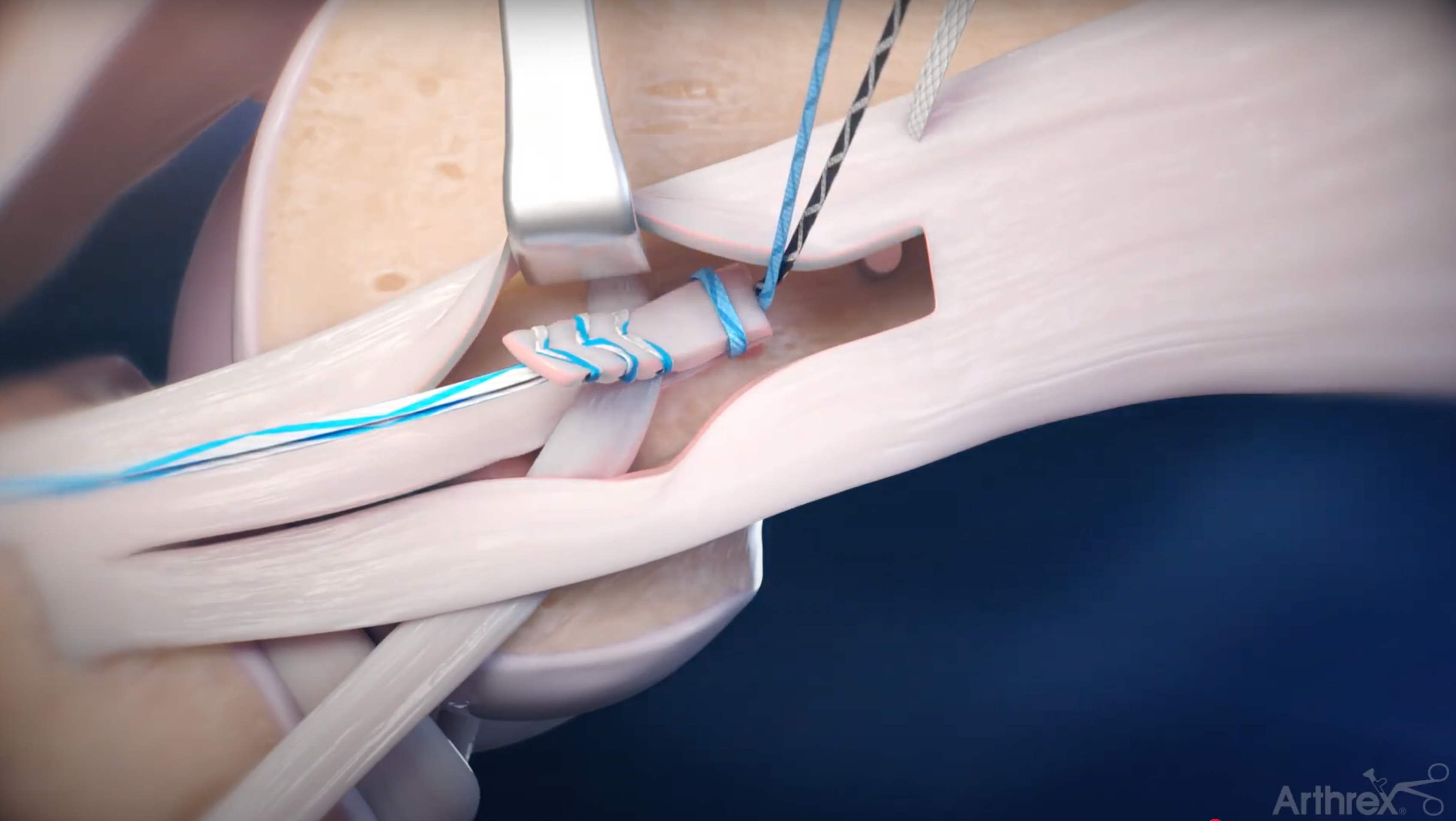 Load video: Iliotibial Band Tenodesis Using the FiberStaple™ Technique