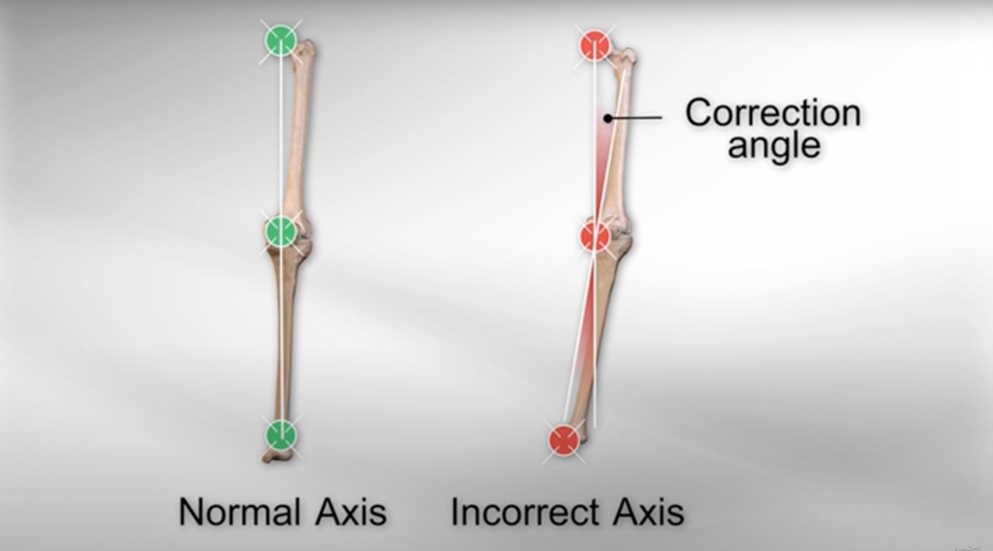 Load video: HTO with Arthrex® iBalance®