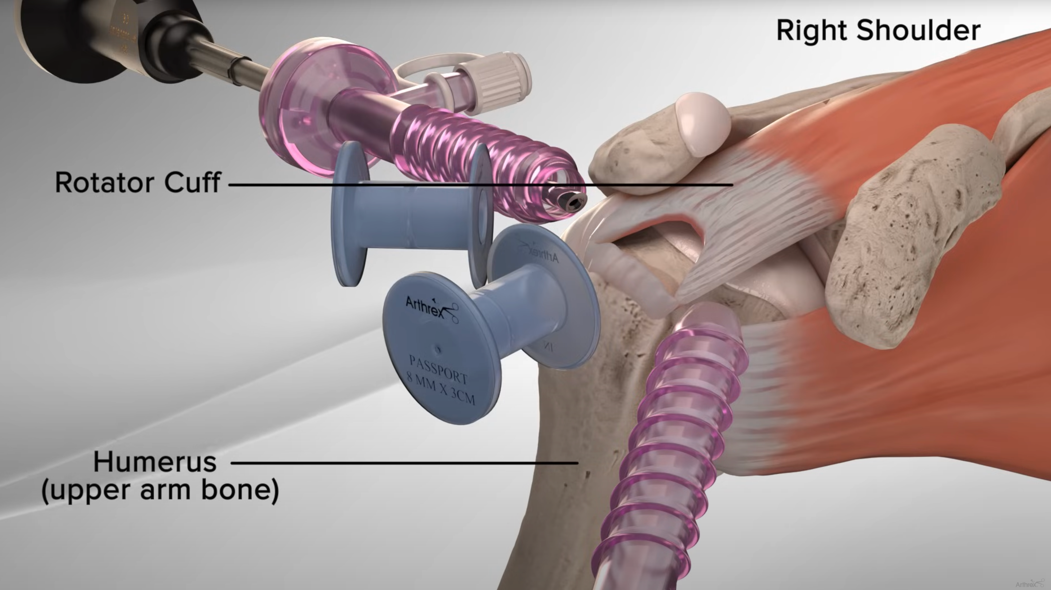 Load video: Rotator Cuff Repair with Arthrex® SpeedBridge™