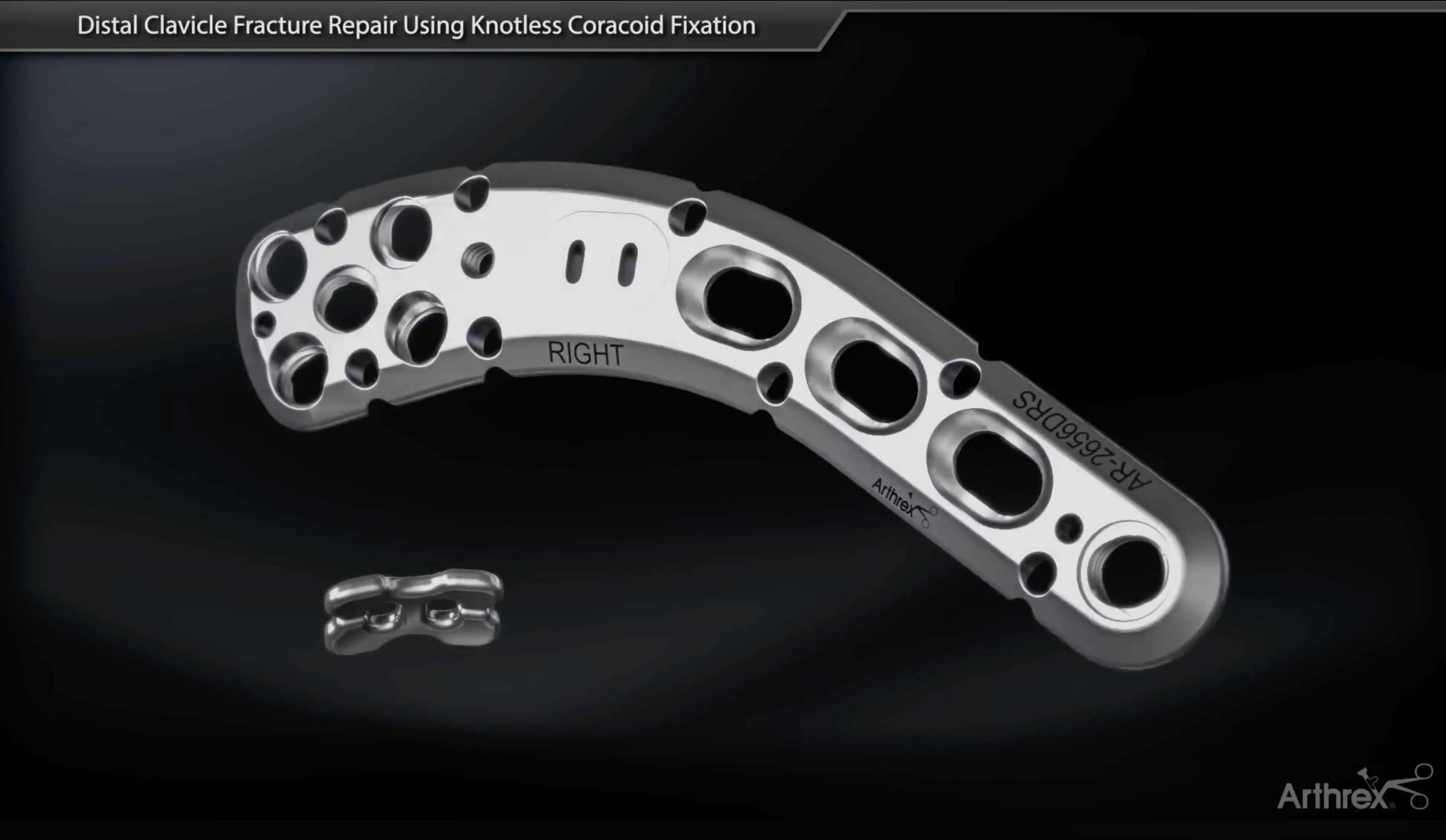 Load video: Arthrex® Distal Clavicle Fracture Repair Using Coracoid Fixation