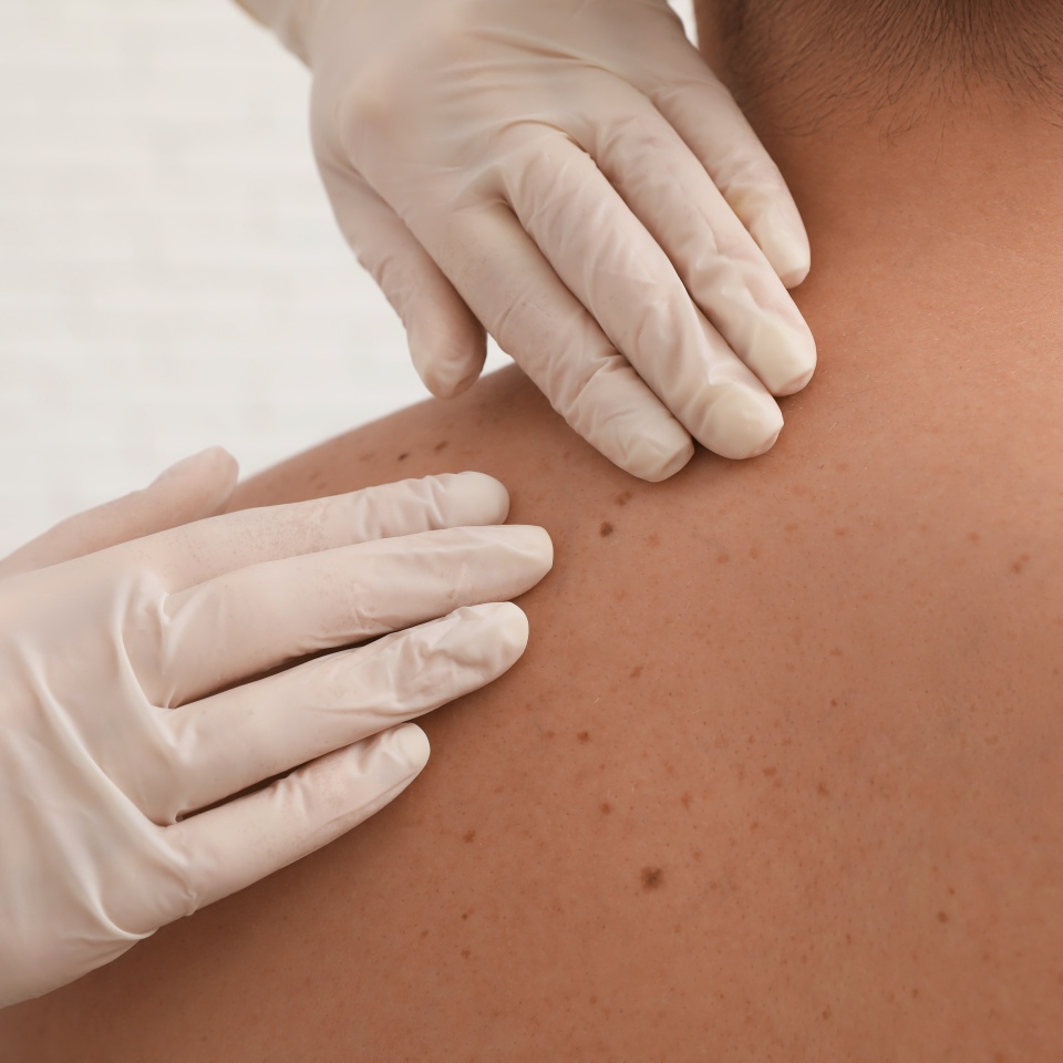 Dermatologist examining patient's birthmark in clinic, closeup