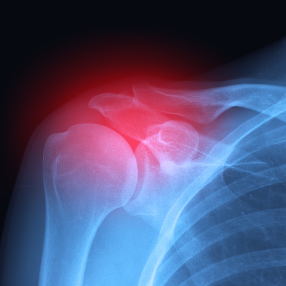 Real X-ray scan - inflammation or broken arm and shoulder trauma pain. Radiology diagnosis.